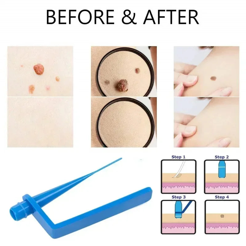 Skin Tag Remover Rubber Band Kit Face Care Mole Wart Tool
